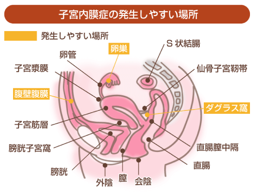 子宮内膜症の発生しやすい場所