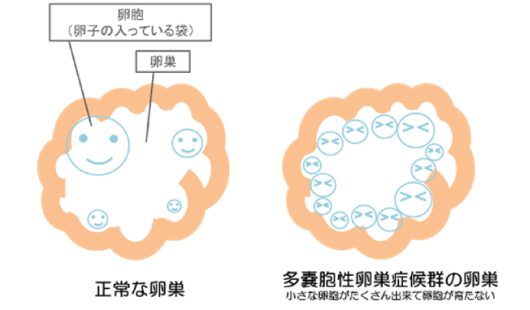 正常な卵巣と多嚢胞性卵巣症候群の卵巣